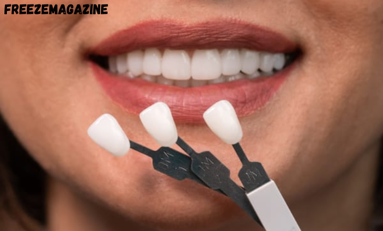 Help Veneers Last Longer