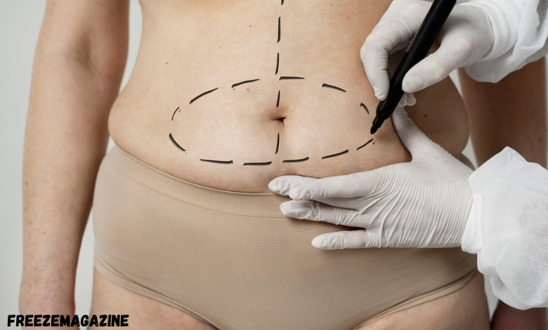 Manchester liposuction